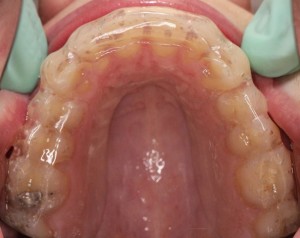 Bruksistična opornica v zgornjem zobnem loku