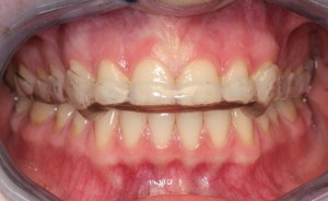 Bruksistična opornica | nočno stiskanje zob | škrtanje z zobmi | bruksizem