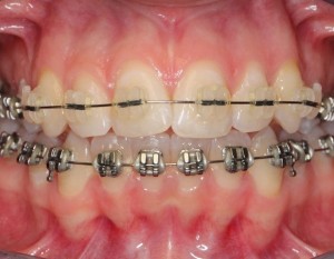 Nesnemni ortodontski aparat