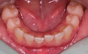 Rahlo dislociran zob