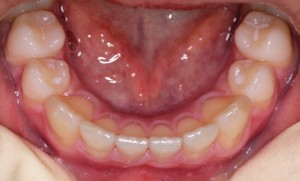 Zobni lok po zdravljenju s termoplastično opornico