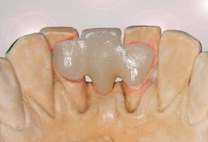 Polnokeramični Maryland mostiček