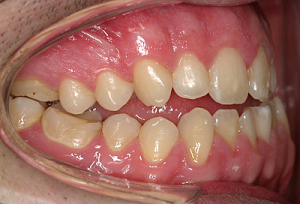 Naprej pomaknjena (prognata) spodnja čeljustnica | Pred zdravljenjem