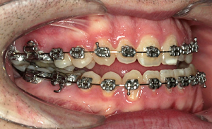 Naprej pomaknjena (prognata) spodnja čeljustnica | Pred kirurškim posegom