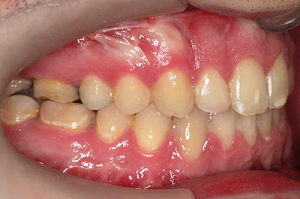 Naprej pomaknjena (prognata) spodnja čeljustnica | Medčeljustni odnos po zdravljenju