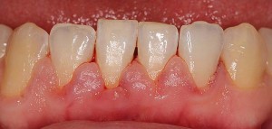 Parodontoza - vnetje obzobnih tkiv