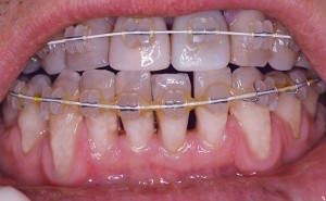 Parodontoza in ortodontske težave