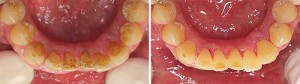 Zobje pred in po čiščenju zobnega kamna