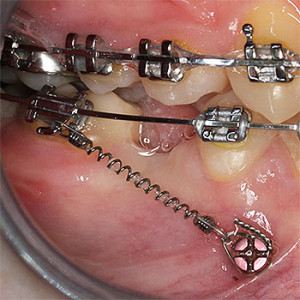 Minivijak | enostavna pomoč pri zapiranju vrzeli zaradi odsotnosti stalnih zob po ekstrakciji ali genetsko pogojene odsotnosti zob