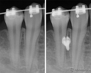 Minivijaki | enostavna pomoč pri zapiranju vrzeli zaradi odsotnosti stalnih zob po ekstrakciji ali genetsko pogojene odsotnosti zob