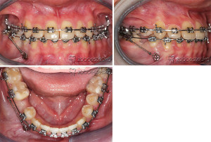 Minivijaki | enostavna pomoč pri zapiranju vrzeli zaradi odsotnosti stalnih zob po ekstrakciji ali genetsko pogojene odsotnosti zob