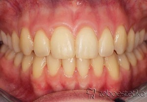 Ortodontsko zdravljenje - Potem