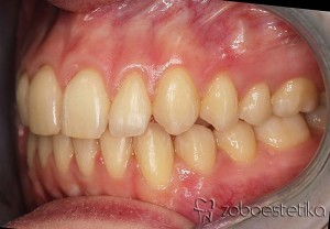 Ortodontsko zdravljenje - Potem