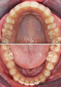 Ortodontsko zdravljenje - Potem