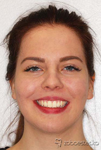 Ortodontsko zdravljenje - Potem