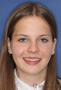 Ortodontsko zdravljenje - Prej