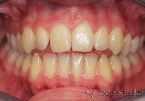 Ortodontsko zdravljenje - Prej