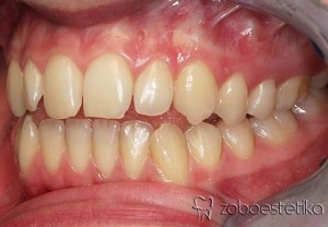 Ortodontsko zdravljenje - Prej