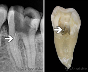 Zlomljena igla v koreninskem kanalu