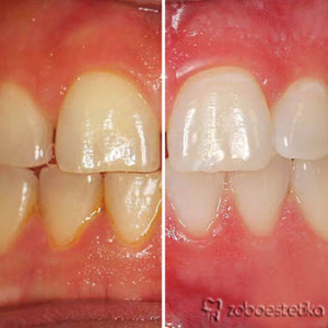 Beljenje zob z ZOOM lučko - Prej in potem