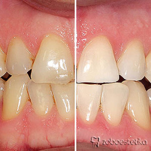 Beljenje zob z ZOOM lučko - Prej in potem