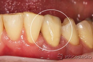 Cirkon keramična prevleka