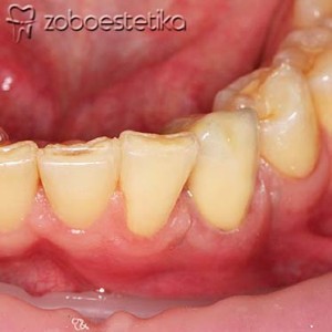 Cirkon keramična prevleka