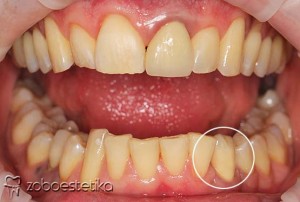 Cirkon keramična prevleka