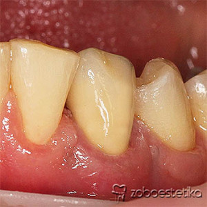 Cirkon keramična prevleka