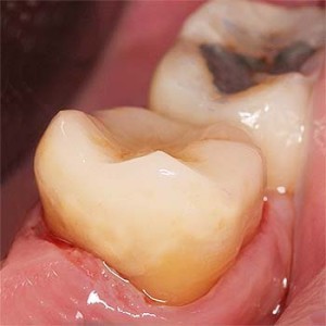 Endo krona (e.max) na endodontsko zdravljenem zobu (drugi levi kočnik spodaj)