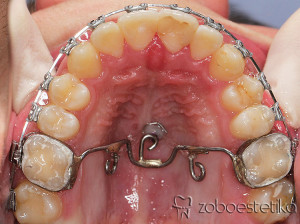 Odprti griz | Intruzija prvih kočnikov / korekcija odprtega griza s transpalatinalnim lokom in minivijakom