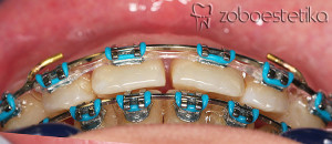 Odprti griz | Intruzija prvih kočnikov / korekcija odprtega griza s transpalatinalnim lokom in minivijakom