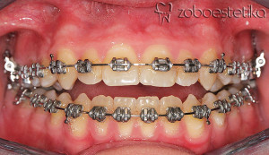 Odprti griz | Intruzija prvih kočnikov / korekcija odprtega griza s transpalatinalnim lokom in minivijakom