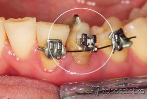 Ortodontski vlek levega spodnjega podočnika