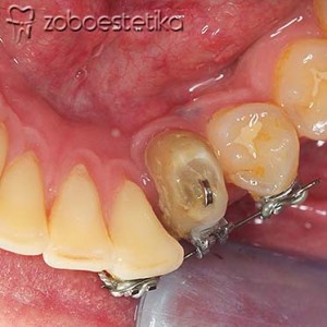Ortodontski vlek levega spodnjega podočnika