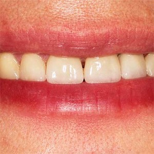 Preobrazba zgornjih sekalcev z zalivkami, polnokeramičnimi estetskimi fasetami in prevlekami