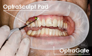 Izdelava estetske fasete - luske s pripomočki Ivoclar Vivadent | OptraGate | OptraSculpt Pad