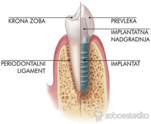 Kaj je zobni implantat?