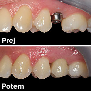 Implantat | cirkon-keramična prevleka sidrana na implantat