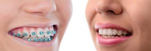 Ortodont - Invisalign ali nosilci (breketi)?