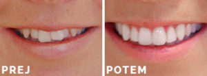 Invisalign primer 001 - Prej in Potem