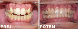 Invisalign primer 002 - Prej in Potem