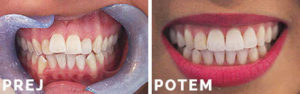 Invisalign primer 003 - Prej in Potem