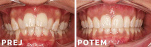 Invisalign primer 004 - Prej in Potem