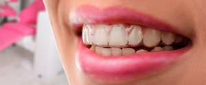 Invisalign ortodont