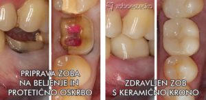 Priprava zoba na beljenje in protetiko ║ Pozdravljen zob s keramično krono