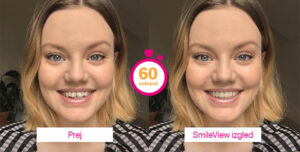 Simulacija vašega nasmeha - Prej in Potem | ZoboEstetika - Invisalign SmileView
